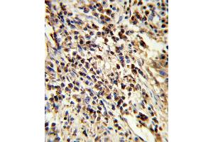 Formalin-fixed and paraffin-embedded human lung carcinoma reacted with PS Antibody (Center), which was peroxidase-conjugated to the secondary antibody, followed by DAB staining. (PSMA7 Antikörper  (AA 100-126))