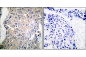 Immunohistochemistry analysis of paraffin-embedded human breast carcinoma tissue, using CPI17 alpha (Ab-38) Antibody. (CPI-17 Antikörper  (AA 5-54))