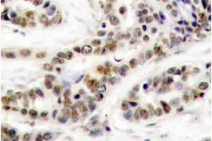 Immunohistochemistry (IHC) analyzes of p-CREB-1 antibody in paraffin-embedded human breast carcinoma tissue. (CREB1 Antikörper  (pSer129))