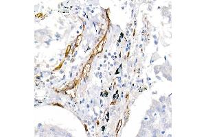Immunohistochemistry of paraffin-embedded human lung cancer using CD146/MCAM Rabbit pAb (ABIN6127568, ABIN6143621, ABIN6143622 and ABIN6218100) at dilution of 1:25 (40x lens). (MCAM Antikörper  (AA 447-646))