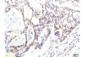 Formalin-fixed and paraffin embedded human colon carcinoma labeled with Anti phospho-CK II beta (Ser209) Polyclonal Antibody, Unconjugated (ABIN872284) at 1:200 followed by conjugation to the secondary antibody and DAB staining. (CSNK2B Antikörper  (pSer209))