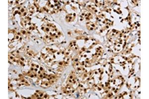 The image on the left is immunohistochemistry of paraffin-embedded Human thyroid cancer tissue using ABIN7190953(HIST1H2AB Antibody) at dilution 1/20, on the right is treated with synthetic peptide. (HIST1H2AB Antikörper)