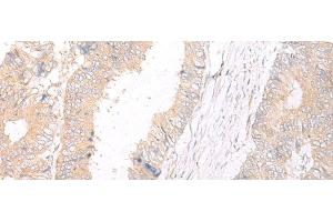 Immunohistochemistry of paraffin-embedded Human colorectal cancer tissue using HLA-C Polyclonal Antibody at dilution of 1:25(x200)
