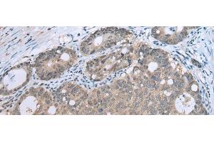 Immunohistochemistry of paraffin-embedded Human gastric cancer tissue using CCNG1 Polyclonal Antibody at dilution of 1:30(x200) (Cyclin G1 Antikörper)
