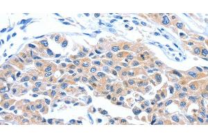 Immunohistochemistry of paraffin-embedded Human lung cancer tissue using ARL11 Polyclonal Antibody at dilution 1:50 (ARL11 Antikörper)