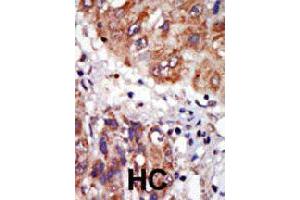 Formalin-fixed and paraffin-embedded human hepatocellular carcinoma tissue reacted with LIMK1 polyclonal antibody  , which was peroxidase-conjugated to the secondary antibody, followed by DAB staining. (LIM Domain Kinase 1 Antikörper  (N-Term))