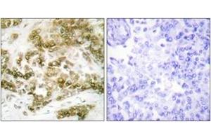 Immunohistochemistry analysis of paraffin-embedded human breast carcinoma tissue, using TBX15/18 Antibody. (T-Box 15/18 Antikörper  (AA 161-210))