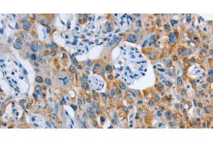 Immunohistochemistry of paraffin-embedded Human lung cancer tissue using ASL Polyclonal Antibody at dilution 1:35 (ASL Antikörper)