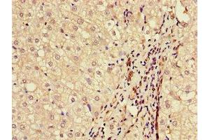 Immunohistochemistry of paraffin-embedded human liver cancer using ABIN7145589 at dilution of 1:100 (BAAT Antikörper  (AA 313-400))