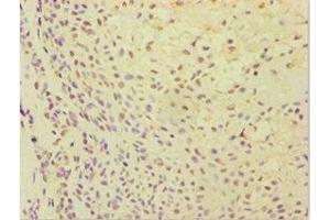 Immunohistochemistry of paraffin-embedded human breast cancer using ABIN7144870 at dilution of 1:100 (ATP5J Antikörper  (AA 1-108))