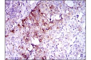 Immunohistochemical analysis of paraffin-embedded cervical cancer tissues using FLT3 mouse mAb with DAB staining. (FLT3 Antikörper  (AA 930-991))