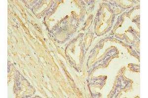 Immunohistochemistry of paraffin-embedded human prostate cancer using ABIN7146360 at dilution of 1:100 (SLC25A25 Antikörper  (AA 1-189))