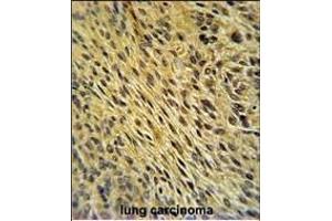 CCDC62 Antibody (C-term) (ABIN651350 and ABIN2840196) immunohistochemistry analysis in formalin fixed and paraffin embedded human lung carcinoma followed by peroxidase conjugation of the secondary antibody and DAB staining. (CCDC62 Antikörper  (C-Term))
