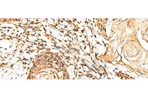 Immunohistochemistry of paraffin-embedded Human esophagus cancer tissue using RETREG1 Polyclonal Antibody at dilution of 1:60(x200)