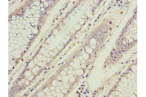 Immunohistochemistry of paraffin-embedded human colon cancer using ABIN7173742 at dilution of 1:100 (TBCC Antikörper  (AA 2-346))