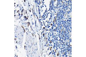 Immunohistochemistry of paraffin-embedded human colon carcinoma using STK19 Rabbit pAb (ABIN6132689, ABIN6148598, ABIN6148600 and ABIN6217358) at dilution of 1:100 (40x lens). (STK19 Antikörper  (AA 75-364))