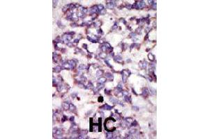 Formalin-fixed and paraffin-embedded human hepatocellular carcinoma tissue reacted with PDK2 polyclonal antibody  , which was peroxidase-conjugated to the secondary antibody, followed by DAB staining . (PDK2 Antikörper  (AA 378-407))