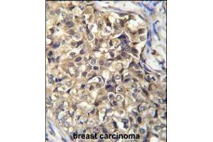 KLHL35 Antibody immunohistochemistry analysis in formalin fixed and paraffin embedded human breast carcinoma followed by peroxidase conjugation of the secondary antibody and DAB staining. (KLHL35 Antikörper  (C-Term))