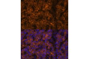 Immunofluorescence analysis of human liver cancer using TTR Polyclonal Antibody (ABIN3021473, ABIN3021474, ABIN3021475 and ABIN6215107) at dilution of 1:100 (40x lens).