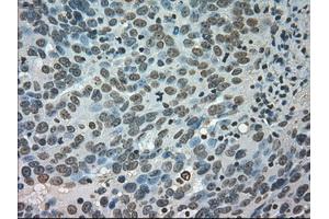 Immunohistochemical staining of paraffin-embedded Adenocarcinoma of colon tissue using anti-CTAG1Bmouse monoclonal antibody. (CTAG1B Antikörper)