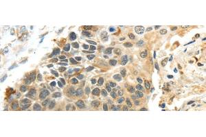 Immunohistochemistry of paraffin-embedded Human esophagus cancer using PROX1 Polyclonal Antibody at dilution of 1/40 (PROX1 Antikörper)