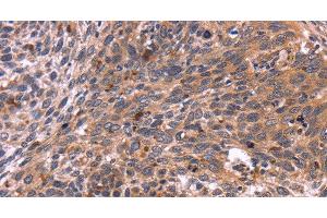 Immunohistochemistry of paraffin-embedded Human cervical cancer tissue using CRK Polyclonal Antibody at dilution 1:40 (Crk Antikörper)