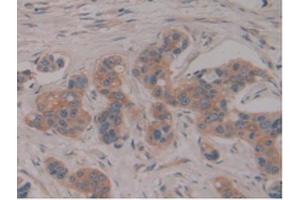 IHC-P analysis of Human Breast Cancer Tissue, with DAB staining. (PSG1 Antikörper  (AA 202-401))