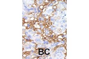 Formalin-fixed and paraffin-embedded human cancer tissue reacted with the primary antibody, which was peroxidase-conjugated to the secondary antibody, followed by DAB staining.