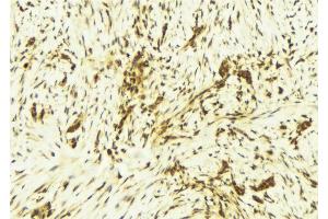 ABIN6269245 at 1/100 staining Human breast cancer tissue by IHC-P. (STAT1 Antikörper)