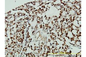 Immunoperoxidase of monoclonal antibody to CDKN1B on formalin-fixed paraffin-embedded human ovary, clear cell carcinoma tissue. (CDKN1B Antikörper  (AA 1-198))