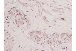 Formalin-Fixed, Paraffin-Embedded Human Sections prostate stained with TSLP Antibody Cat. (Thymic Stromal Lymphopoietin Antikörper)