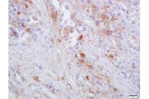 Formalin-fixed and paraffin embedded human lung carcinoma labeled with Anti-CCR-2 Polyclonal Antibody, Unconjugated (ABIN670146) at 1:200 followed by conjugation to the secondary antibody and DAB staining (CCR2 Antikörper)