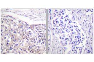 Immunohistochemistry analysis of paraffin-embedded human breast carcinoma tissue using p90 RSK (Phospho-Thr573) antibody. (RPS6KA3 Antikörper  (pThr573))