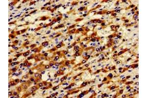 Immunohistochemistry of paraffin-embedded human liver cancer using ABIN7143372 at dilution of 1:100 (GPR124 Antikörper  (AA 1069-1338))