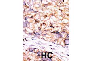 Formalin-fixed and paraffin-embedded human hepatocellular carcinoma tissue reacted with CTDSP1 polyclonal antibody  , which was peroxidase-conjugated to the secondary antibody, followed by DAB staining. (CTDSP1 Antikörper  (C-Term))