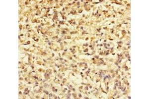 Immunohistochemistry of paraffin-embedded human melanoma using ABIN7172299 at dilution of 1:100 (TMEFF2 Antikörper  (AA 41-320))