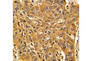 IHC analysis of FFPE human lung carcinoma with Fascin antibody (Fascin Antikörper  (AA 322-350))