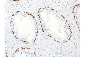 Formalin-fixed, paraffin-embedded human Prostate Carcinoma stained with p63 Mouse Monoclonal Antibody (TP63/2427).