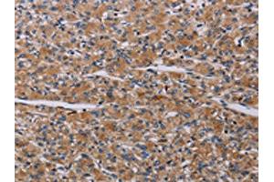 The image on the left is immunohistochemistry of paraffin-embedded Human prostate cancer tissue using ABIN7191790(PARP4 Antibody) at dilution 1/20, on the right is treated with synthetic peptide. (PARP4 Antikörper)