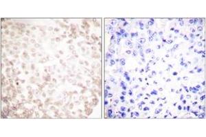 Immunohistochemistry analysis of paraffin-embedded human lung carcinoma tissue, using XRCC1 Antibody. (RCC1 Antikörper  (AA 517-566))