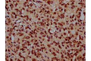IHC image of ABIN7162006 diluted at 1:300 and staining in paraffin-embedded human glioma performed on a Leica BondTM system. (TMEM48 Antikörper  (AA 385-517))