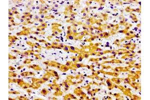 Immunohistochemistry of paraffin-embedded human liver cancer using ABIN7164629 at dilution of 1:100 (USP9X Antikörper  (C-Term))