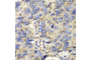 Immunohistochemistry of paraffin-embedded human liver cancer using SDHA antibody at dilution of 1:100 (400x lens).