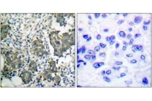 Immunohistochemistry analysis of paraffin-embedded human breast carcinoma tissue, using Keratin 8 (Ab-73) Antibody. (KRT8 Antikörper  (AA 41-90))