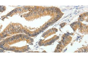 Immunohistochemistry of paraffin-embedded Human colon cancer tissue using MDK Polyclonal Antibody at dilution 1:60 (Midkine Antikörper)