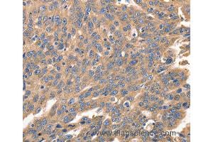 Immunohistochemistry of Human ovarian cancer using IRF1 Polyclonal Antibody at dilution of 1:40 (IRF1 Antikörper)