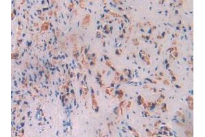 IHC-P analysis of Human Prostate Gland Cancer Tissue, with DAB staining. (Butyrylcholinesterase Antikörper  (AA 29-150))