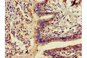 Immunohistochemistry of paraffin-embedded human lung cancer using ABIN7143291 at dilution of 1:100 (ADK Antikörper  (AA 18-256))