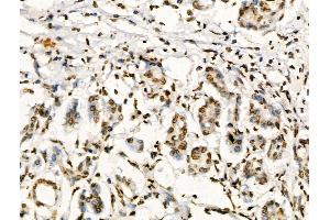 Phospho-Foxp3 (Ser19) Antibody at 1/100 staining Human pancreatic cancer by IHC-P. (FOXP3 Antikörper  (pSer19))