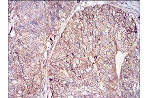Immunohistochemical analysis of paraffin-embedded ovarian cancer tissues using FTL mouse mAb with DAB staining.